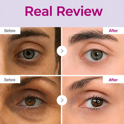 Dark Spot Eye Cream - Defeat Eye Bags In Minutes