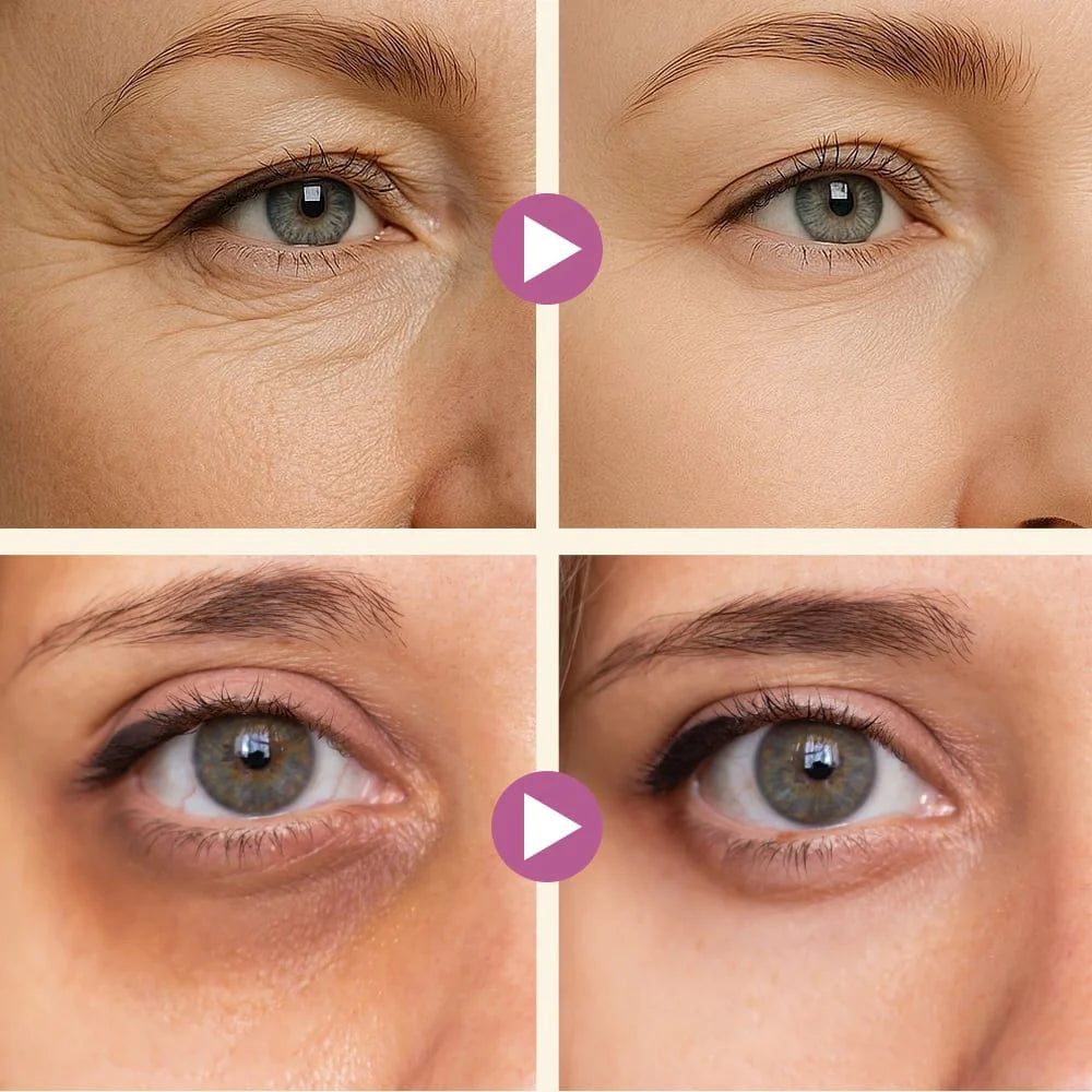 Dark Spot Eye Cream - Defeat Eye Bags In Minutes